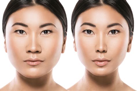 Korean Nose Job Before And After See The Differece Rhinoplasty Sydney Cost