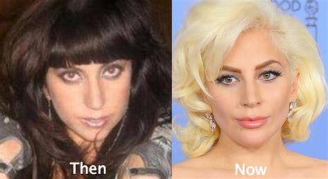 Lady Gaga Plastic Surgery Before And After Photos
