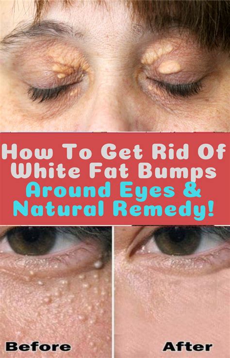 Pin On Reduce Face Fat Home Remedies