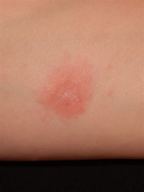 Itchy Red Skin Bumps On Body Images And Photos Finder