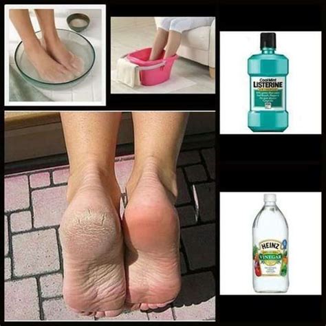 Diy Listerine Foot Soak Recipe Heal Cracked Heels At Home