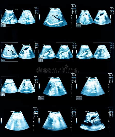 Ultrasound Scan Image Of Abdomen Medical Diagnostic Stock Photo