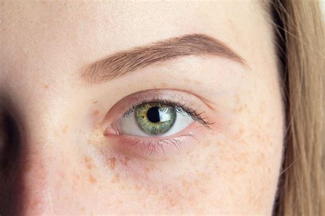 Freckles Types Symptoms Causes Risk Factors And Prevention