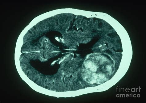 Brain Cancer Ct Scan Photograph By Scott Camazine Pixels