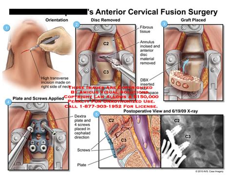 Amicus Illustration Of Amicus Surgery Anterior Cervical Fusion Spine