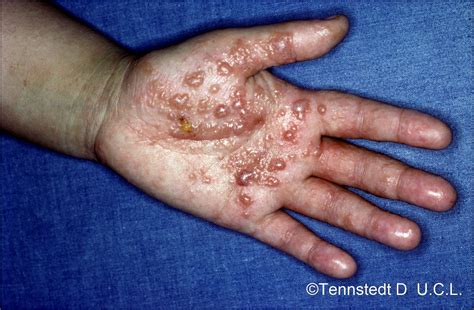 (date à préciser) du grec ancien δυσίδρως, dysidrôs. Dysidrose palmoplantaire - Atlas de dermatologie ...