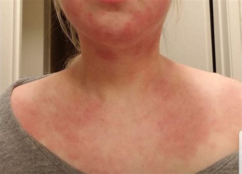 Nummular Eczema Treatment Explained Need To Know More Big Mallrat