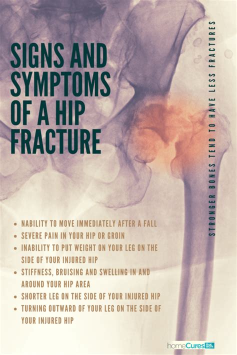Hip Fractures Are Rarely In The Actual Joint Because They Are Fractures