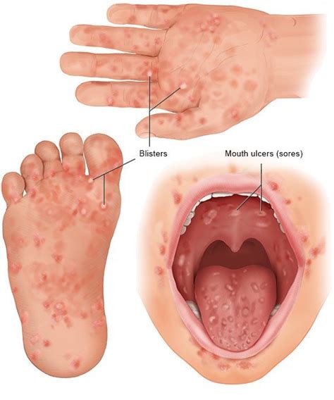Hand Foot And Mouth Disease Mind The Bleep