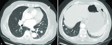 On Lung Window Images Of The Chest Ct Scan A 14 Mm Sized