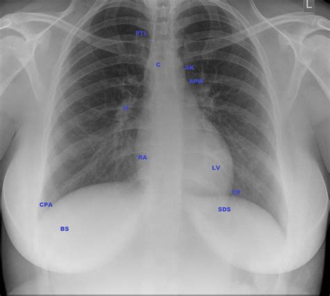The left and the right sides of the heart are separated by walls of tissue known as septums. Normal CXR - female | Image | Radiopaedia.org