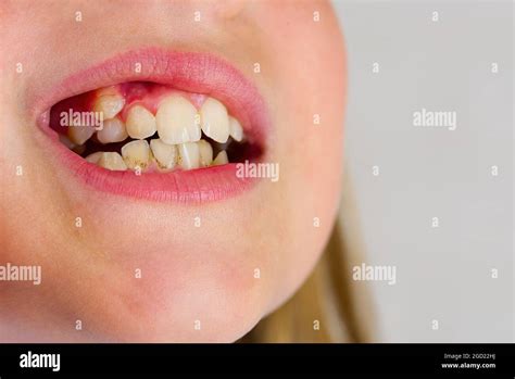 Curved Young Girl Teeth Before Installing Braces Close Up Of A Mouth