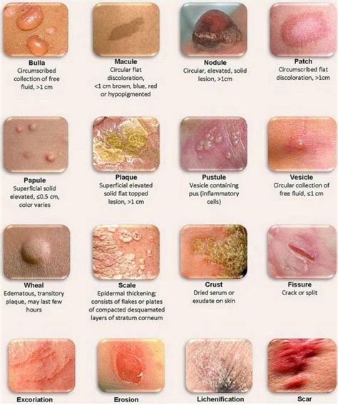 Different Types Of Skin Lesions My Xxx Hot Girl