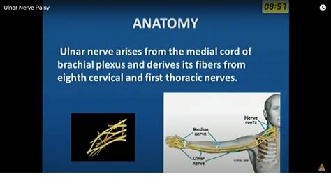 Figure Ulnar Nerve Palsy Following Closed Fracture Of The Distal My