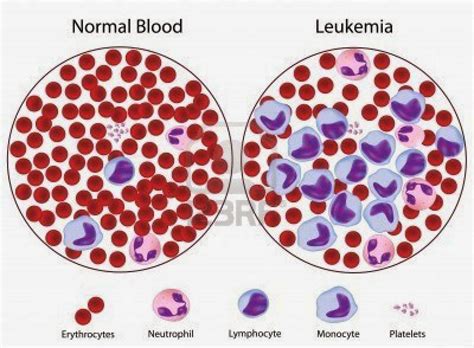 Diagnosis Diagnosis Of Leukemia