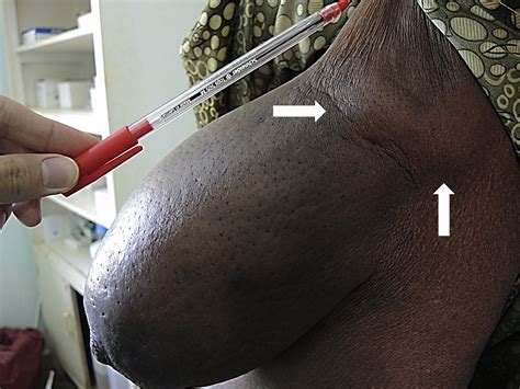 Woman With Swelling Of The Left Breast Annals Of Emergency Medicine