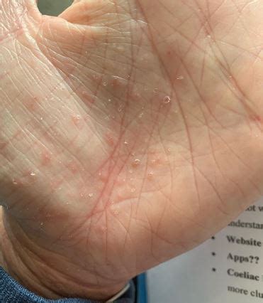 Mild Dyshidrotic Eczema Palms