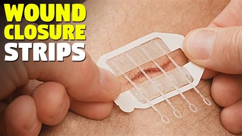 No More Stitches With Easy Wound Closure Strips Youtube