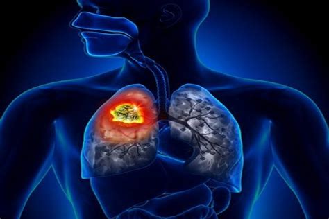 Lung Cancer Overview Symptoms Types Diagnosing Causes And
