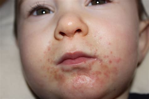 They often form around the mouth and nose but can easily spread to. rash around toddlers mouth - pictures, photos