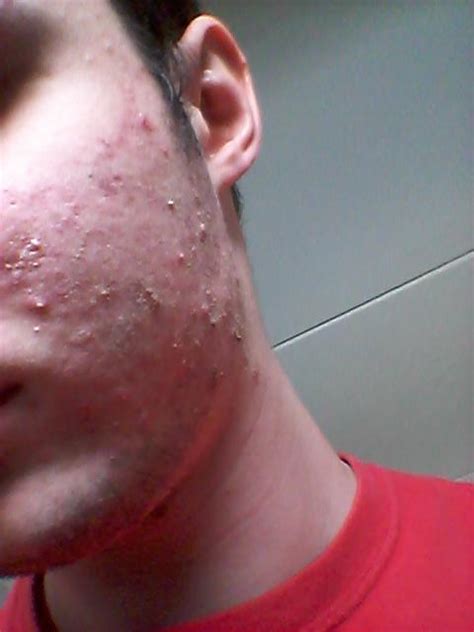 Help Insanely Itchy Face Breakout General Acne Discussion