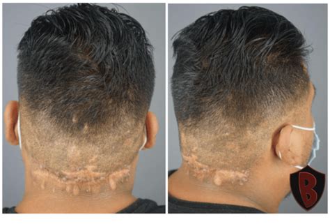 Surgical And Laser Removal Of Multiple Akn Razor Bumps