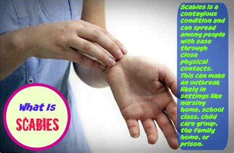 Scabies Home Remedies