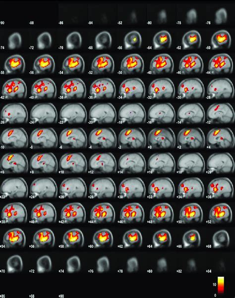 Fmri Bold Activity For The On Off Contrast Fig 1 Shows Bold Activity