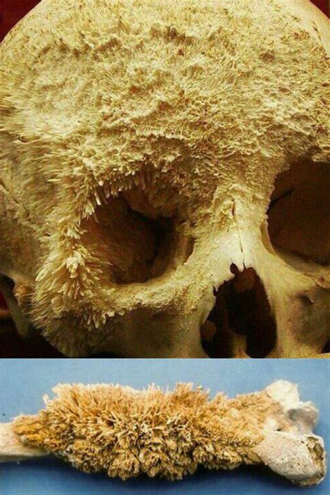 Yesterday when i was sitting in the room and doing my homework i heard my grandmother's voice: Bone cancer : Damnthatsinteresting