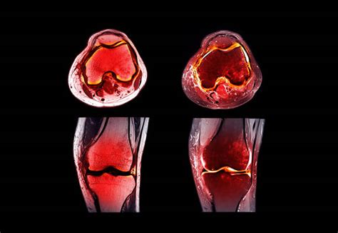 Magnetic Resonance Imaging Or Mri Knee Joint Comparison Coronal And