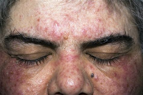 Acne Rosacea On The Face In A Woman Stock Image C0103377 Science