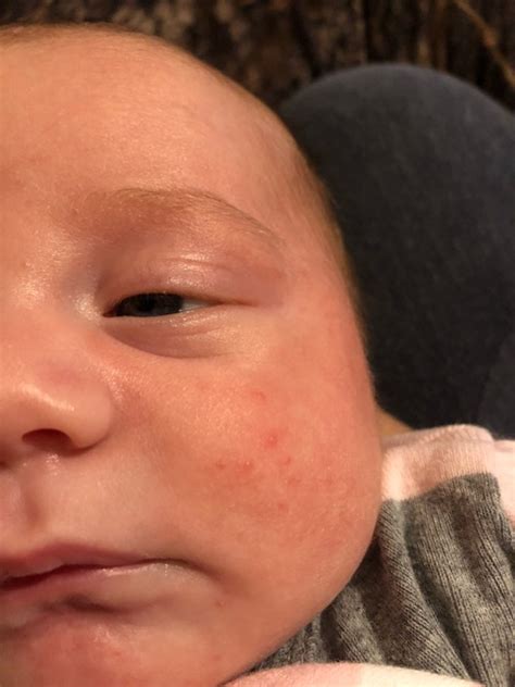 1 Month Old Red Bumps On Face Glow Community