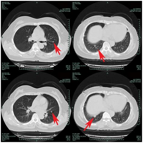 Calcified Nodule In Lung Ct Scan Ct Scan Machine Images