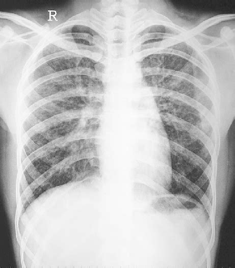 Chest Radiograph Showed Bilateral Extensive Haziness And Reticulation