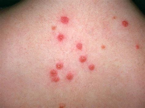 If you are hypersensitive to flea bites then the welts may be much larger, and bleed, if this is the case you definitely need to see a doctor as soon as possible. image of flea bites - pictures, photos