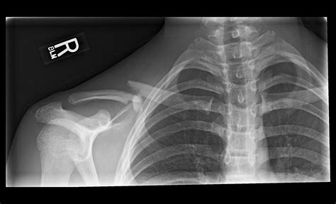 Ortho Dx Clavicle Discomfort Following A Fall Clinical Advisor