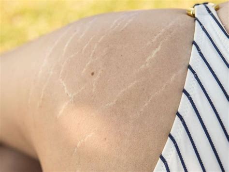 Stretch Marks Are Common During Periods Of Sudden Growth While They