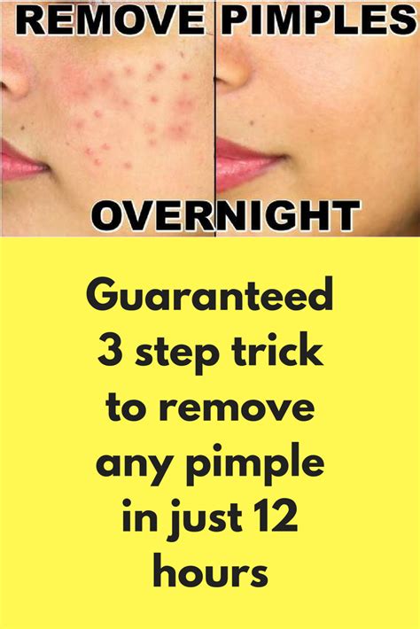 How To Treat Pimples Locally Howtormeov