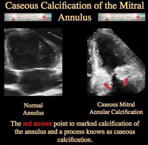 Pdf Caseous Calcification Of The Mitral Annulus In A Cardiac Arrest Hot Sex Picture
