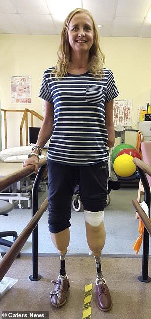 Nurse 51 Has Both Legs And Her Arm Amputated Due To Deadly Sepsis Worldmedicinefoundation