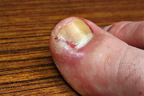 Cracked Toes Pictures Stock Photos Pictures And Royalty Free Images Istock