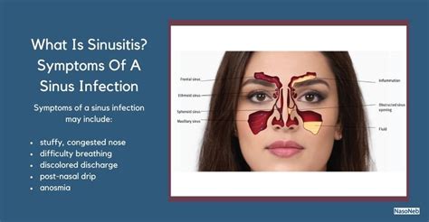 Sinus Infection Sinusitis Causes Symptoms Treatment Atelier Yuwa