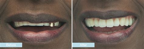 Dentures Before And After Photos Denture Case Studies Changing Faces
