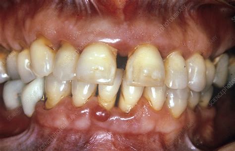 Severe Gum Disease Stock Image C0235439 Science Photo Library