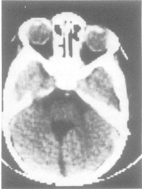 Case 2 Ct Showing An Enlarged Fourth Ventricle Communicating With