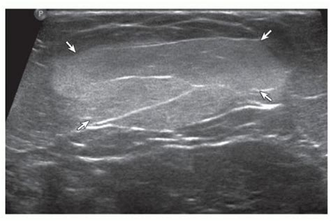 Lipoma Ultrasound Image Shows Oval Hyperechoic Subcutaneous Lipoma