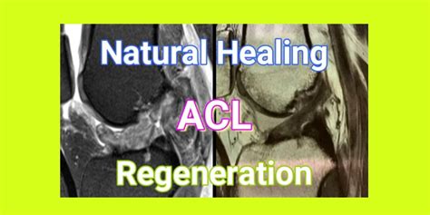 Natural Healing Of A Complete Acl Tear In Children Case 24