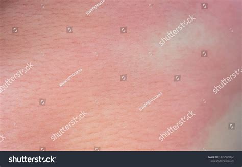 Severe Eczema Skin Rash Allergic Reaction Stock Photo 1476585062