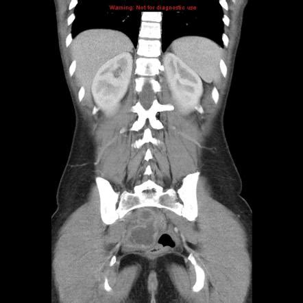 Tubo Ovarian Abscess Radiology Reference Article Radiopaedia Org