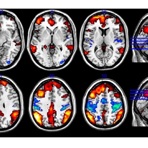 Functional Magnetic Resonance Imaging Fmri Contrast For The Cra Vs